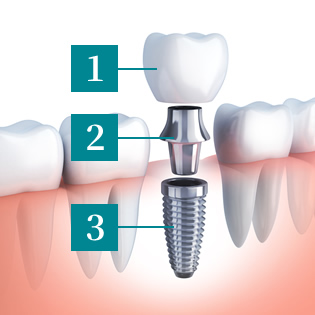 インプラント 構造